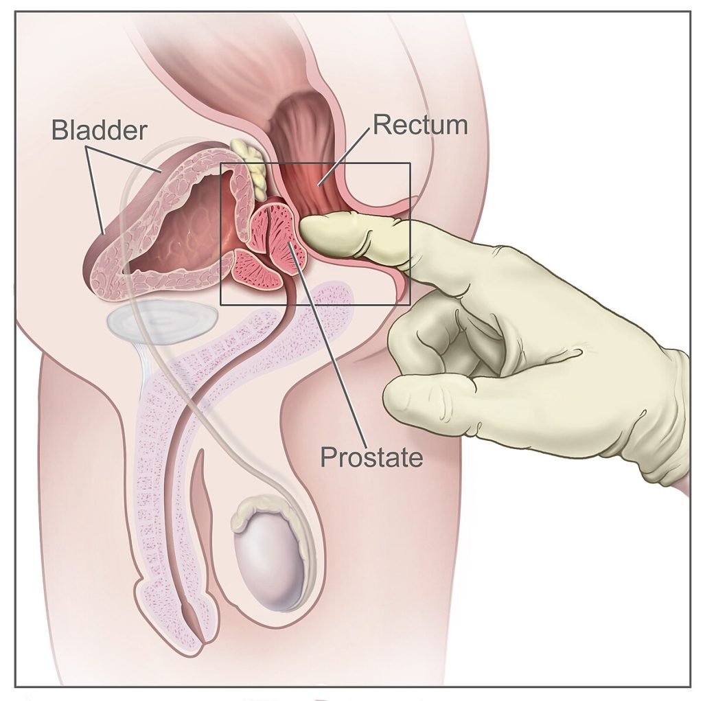 Illustration showing prostate location inside the male pelvis relative to the rectum and bladder